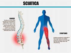 Image result for L3 L4 Sciatica