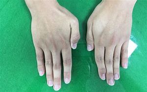 Image result for First Dorsal Interosseous Atrophy