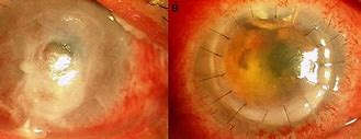 Image result for Corneal Perforation