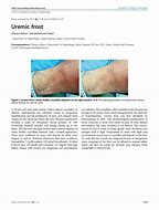 Image result for Uremic Frost On Skin