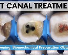 Image result for Mandibular 2nd Pre Molar