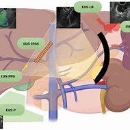 Image result for Biloma Ultrasound Images Post-Cholecystectomy