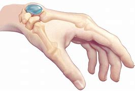 Image result for Cyst On Wrist