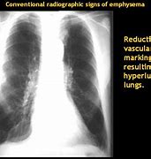 Image result for Distal Acinar Emphysema