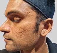 Image result for Open Nose Pores