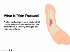 Image result for Open Pilon Fracture