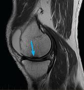 Image result for Knee Meniscus Location