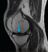 Image result for Right Knee Meniscus