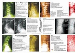 Image result for Spinal DIC Chart