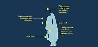 Image result for Achondroplasia Height Chart