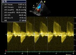 Image result for Aortic Stenosis Doppler