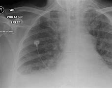 Image result for Acute Pulmonary Oedema and Fluid Overload