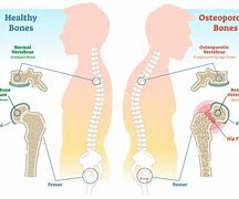 Image result for Osteoporosis Lumbar Spine