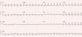 Image result for Polymorphic Wide Complex Tachycardia