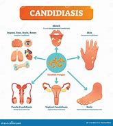 Image result for Candida Throat Infection