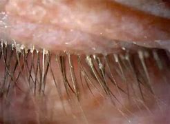 Image result for Eyelash Mite Removal