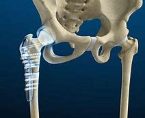 Image result for Orif Hip