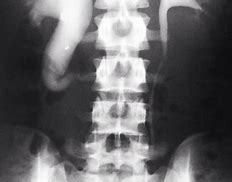 Image result for Retrocaval Ureter X-ray