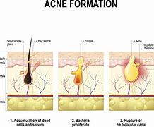 Image result for How to Get Rid Acne Bumps