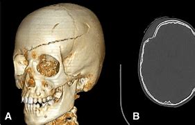 Image result for Skull Fracture