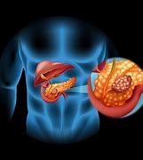 Image result for Pancreatic Cancer