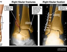 Image result for Lateral Malleolus Fracture Splint