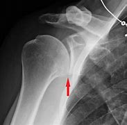 Image result for Arthritc Shoulder