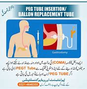 Image result for PEG Tube Replacement