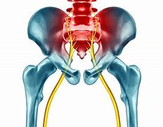 Image result for L3 L4 Sciatica