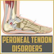 Image result for Peroneal Tendinopathy