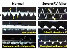 Image result for Nonphasic Venous Flow