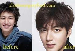 Image result for Lee Min Ki Plastic Surgery