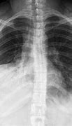 Image result for Left Lower Lobe Pneumonia