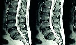 Image result for Lumbar Spine MRI 8Mm