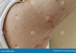 Image result for Hives with Pustules