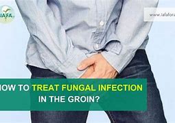 Image result for Heat Rash Fungal Infection