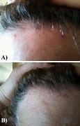 Image result for De Qinjection Atrophy Skin