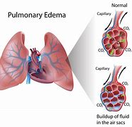 Image result for Acute Lung Oedema