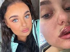 Image result for Bad Lip Fillers