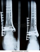 Image result for X-ray of Leg with Metal Plates