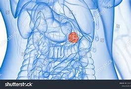 Image result for Kidney Cancer Tumor