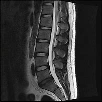 Image result for MRI Scan Lower Back