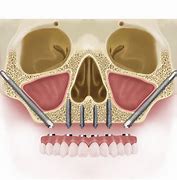 Image result for Zygomatic Implant Surgery