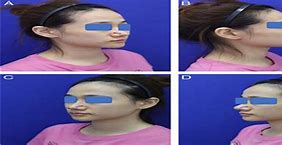 Image result for Nasal Alar Groove