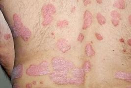 Image result for Candida Rash