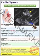 Image result for Cardiac Myxoma