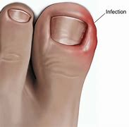 Image result for Ingrown Tools