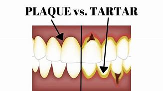 Image result for Tartar Buildup Wisdom Teeth