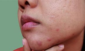 Image result for Acne Under Chin