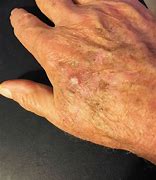 Image result for Skin Cancer On Back of Hand